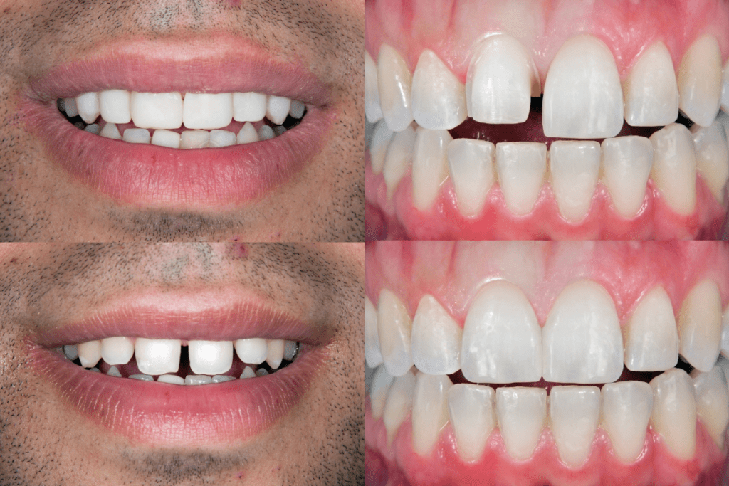 before and after dental 2