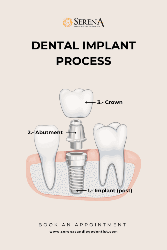 dental implants prices