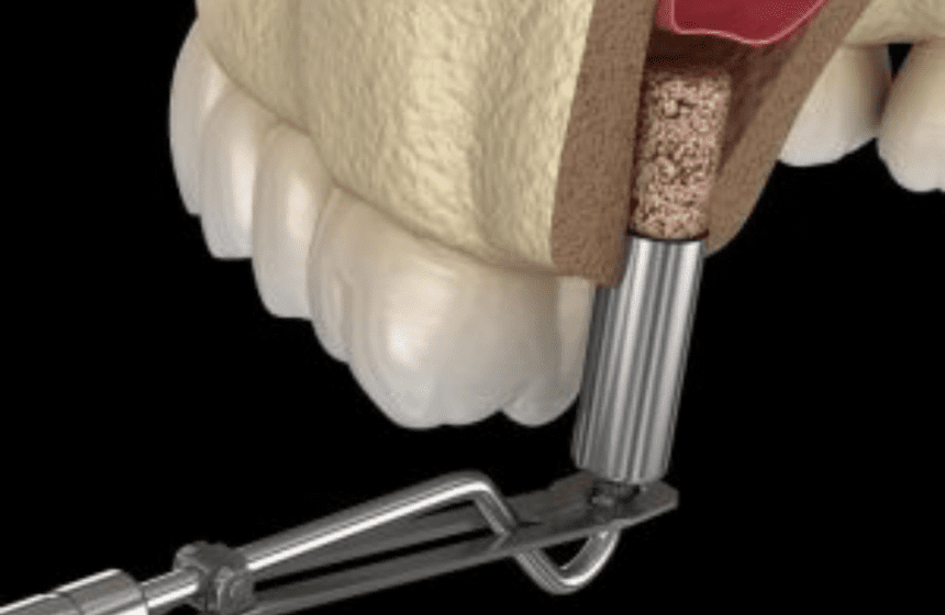 bone grafting