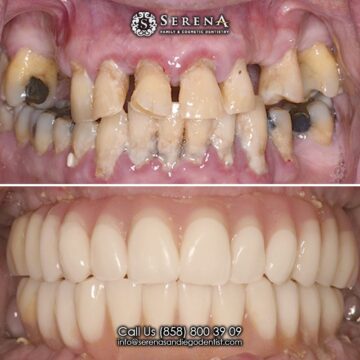 complete smile makeover porcelain veneers near me