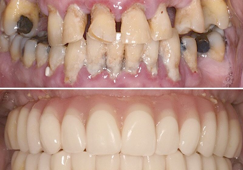 complete smile makeover porcelain veneers near me