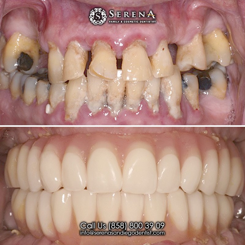 complete smile makeover