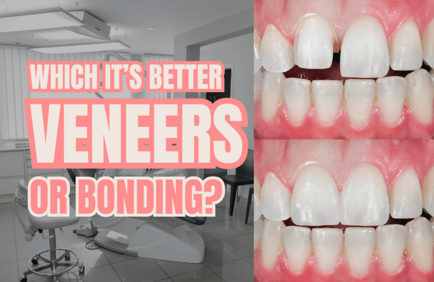 dental bonding vs veneers