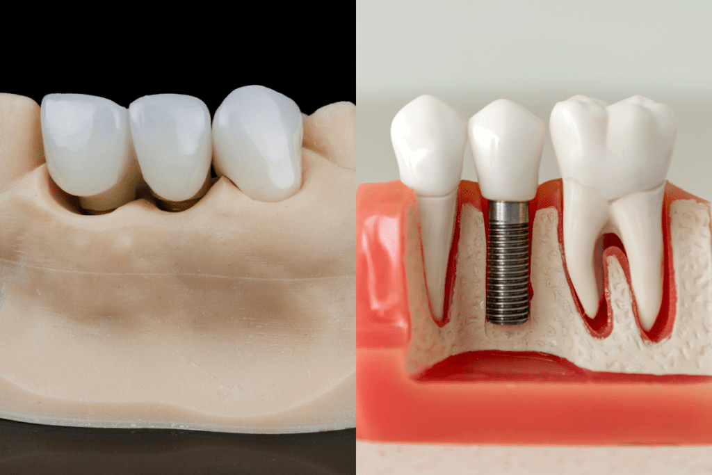 dental bridge vs implant