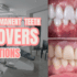 permanent teeth covers