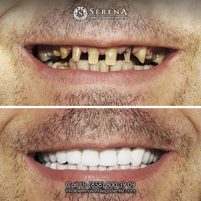 dental treatment before and after Serena 12