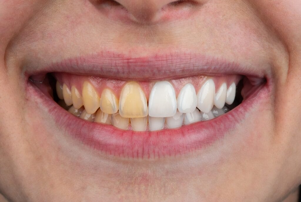 How to Get Rid of Yellow Teeth