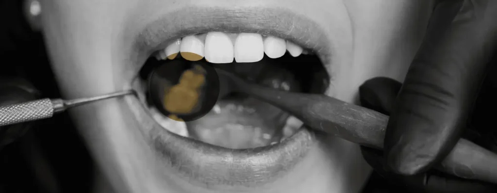 Caring for Your Teeth With Fillings