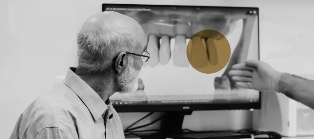 Preparing for a Bone Graft
