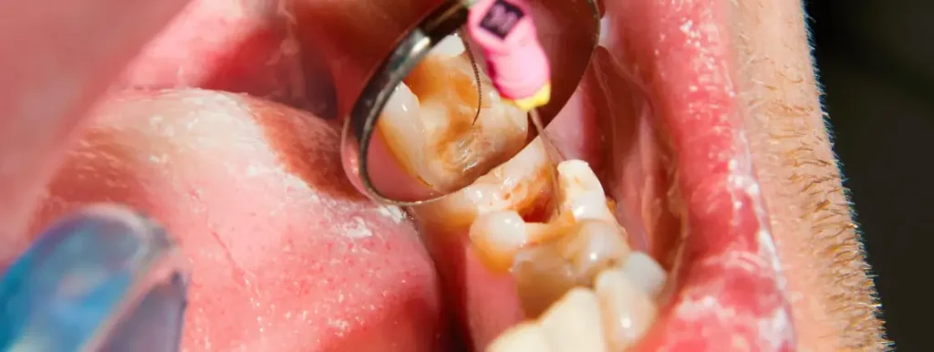 Root Canal or Tooth Extraction