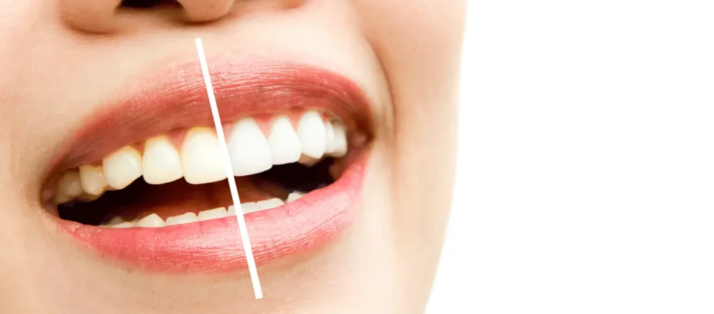 Teeth Whitening